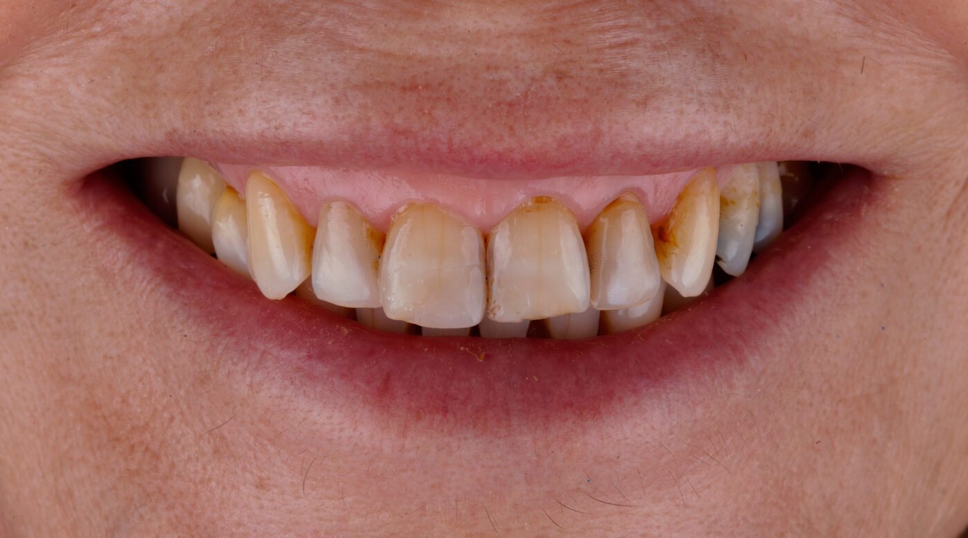 Antes - Caso 3